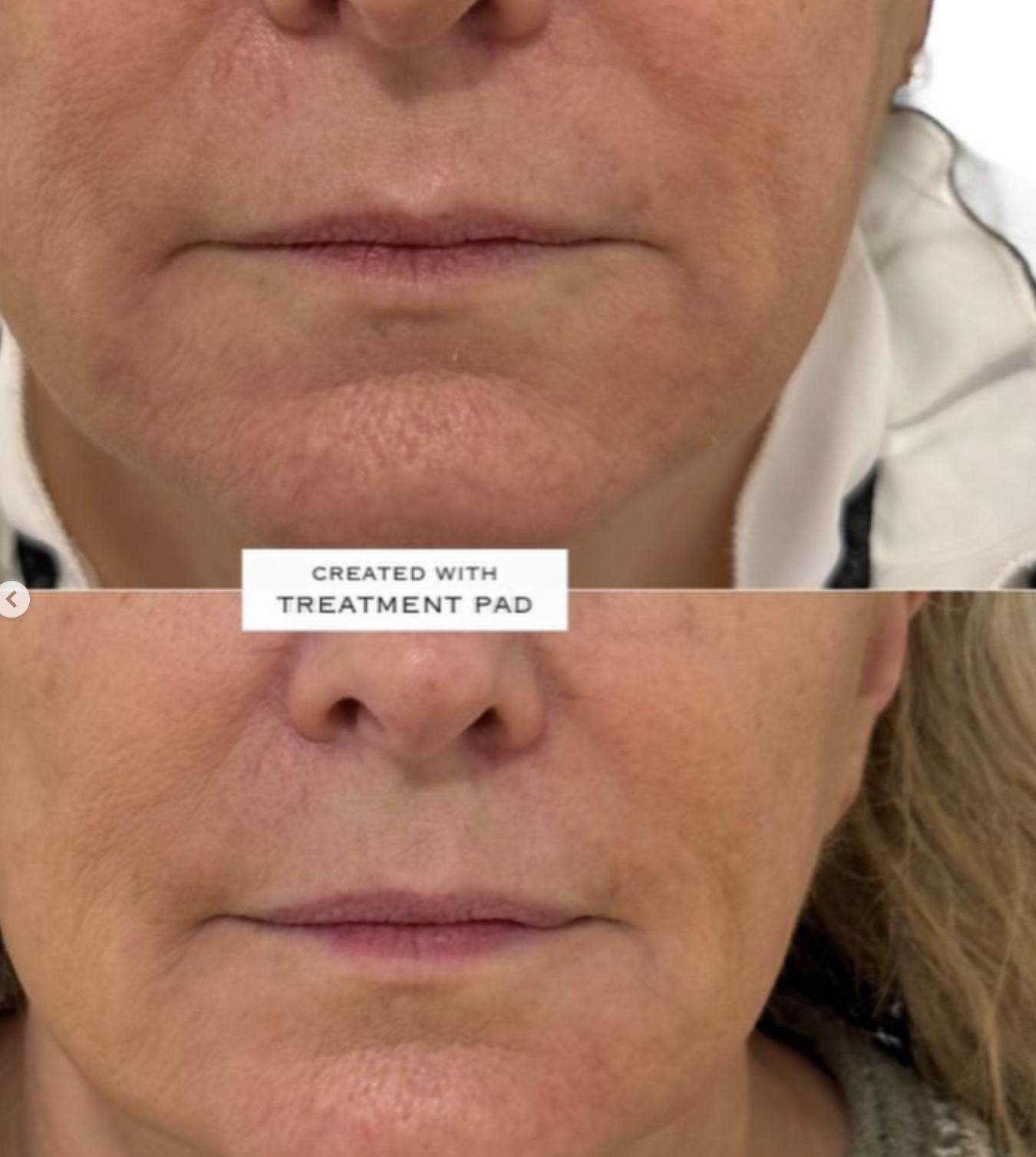 Kenz Beauty client skin result 4, before and after treatment