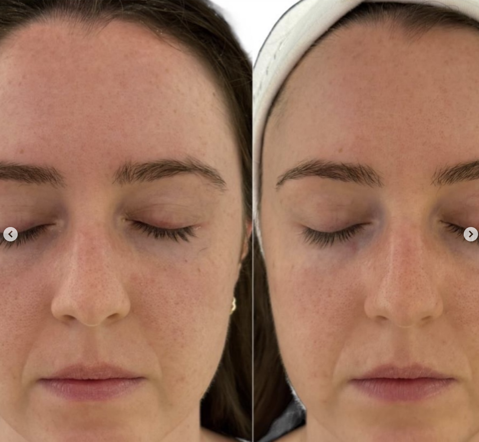 Kenz Beauty client skin result 2, before and after treatment